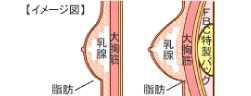 図：大胸筋下法