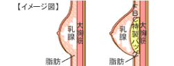 図：乳腺下法